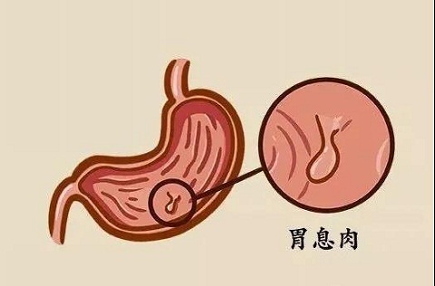 胃息肉会产生哪些症状和危害？